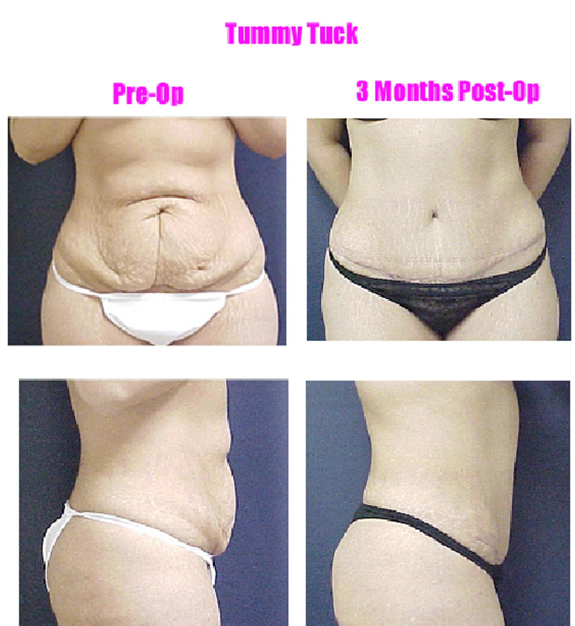 My Experience With Liposuction and a Tummy Tuck as a Patient With
