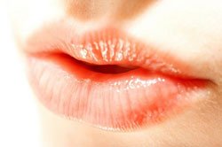 extreme lip augmentation 