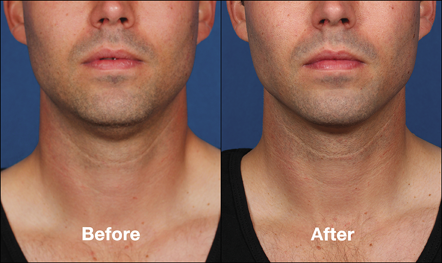 Before and after treatment with Kybella 