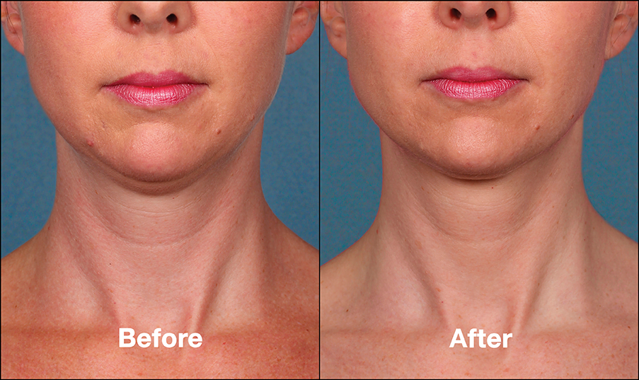 Before and after treatment with Kybella 