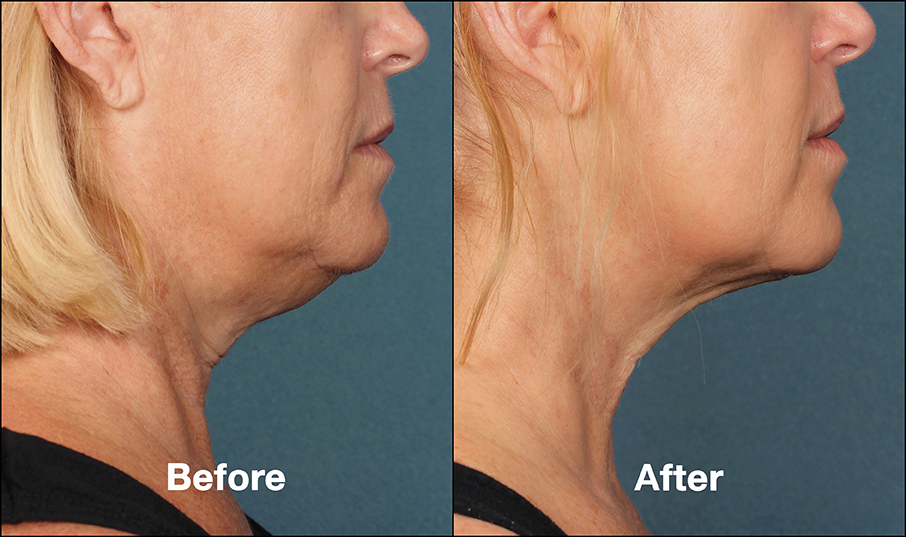 Before and after treatment with Kybella 