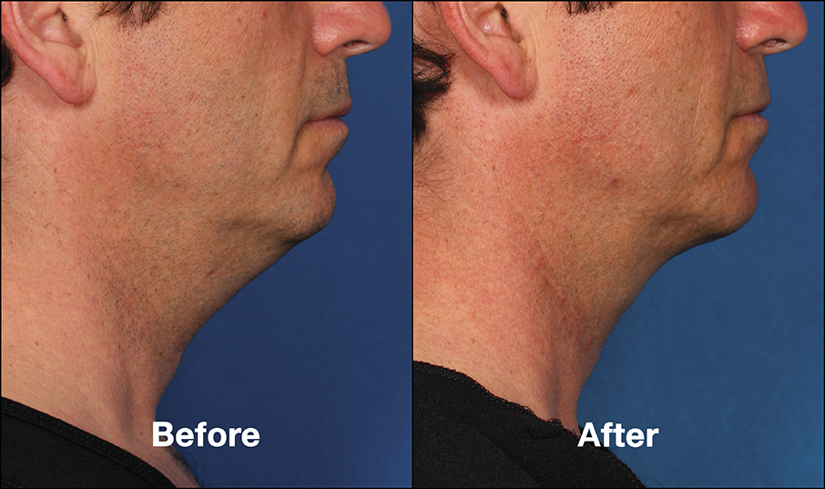 Before and after treatment with Kybella 