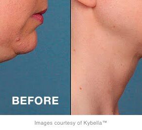 Learn How to Ditch Your Double Chin at Our Kybella Open House!