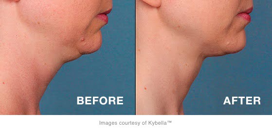 Learn How to Ditch Your Double Chin at Our Kybella Open House!