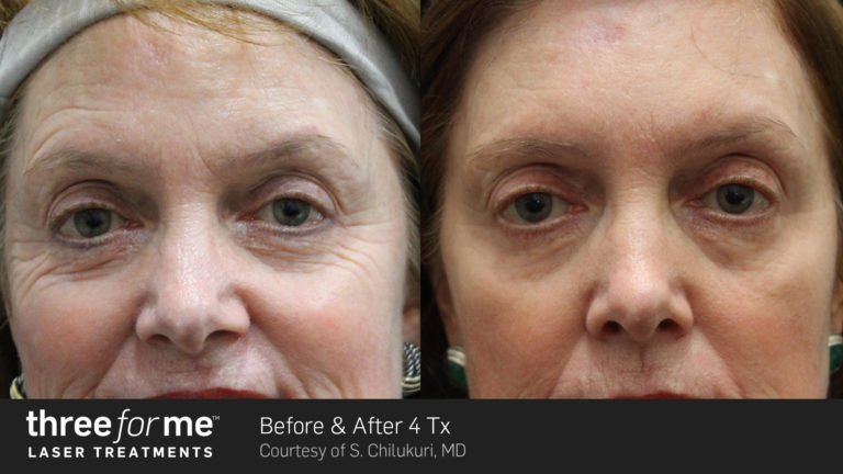 Before and after ICON laser treatments