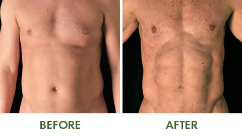 Before and after VASER liposuction