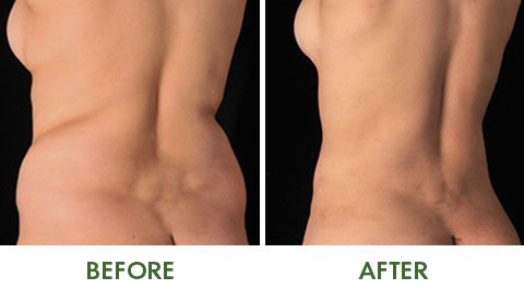 Before and after VASER liposuction