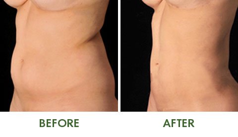 Before and after VASER liposuction