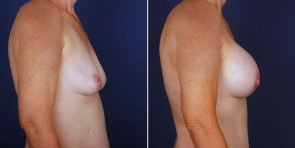 breast-augmentation-14020c-haiavy