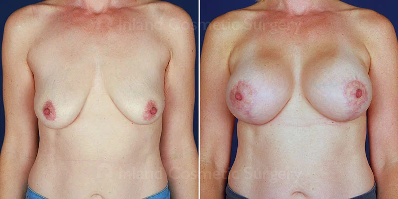Breast Augmentation Patient