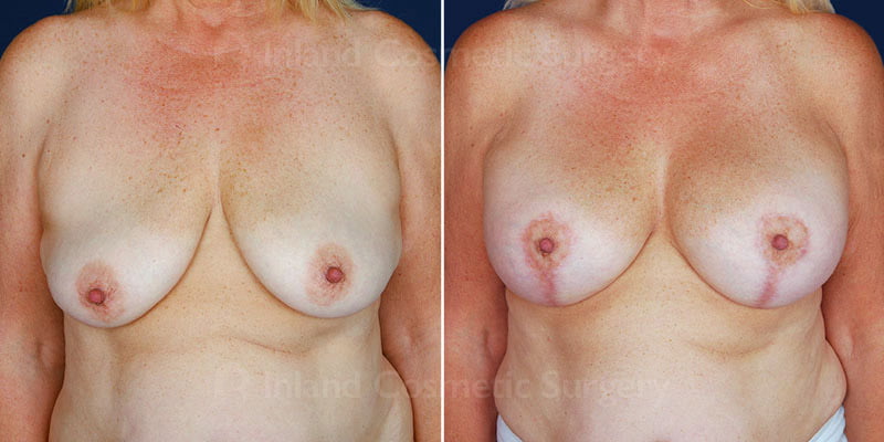 Breast Lift with Augmentation Patient