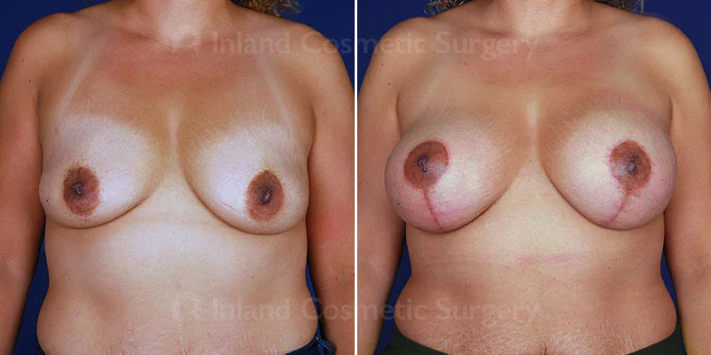 Breast Lift with Augmentation Patient