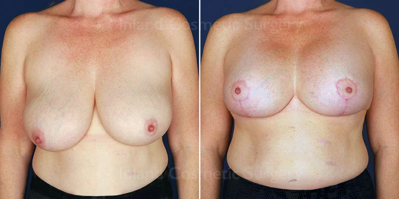 Breast Lift with Augmentation Patient