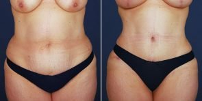 tummy-tuck-liposuction-14076a-haiavy