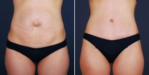 tummy-tuck-liposuction-hernia-repair-14056a-haiavy