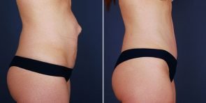 tummy-tuck-liposuction-hernia-repair-14056c-haiavy
