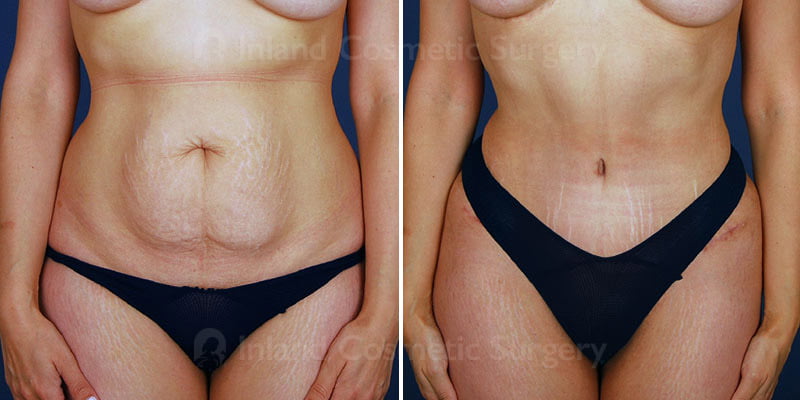 Mini Tummy Tuck with VASER liposuction Patient