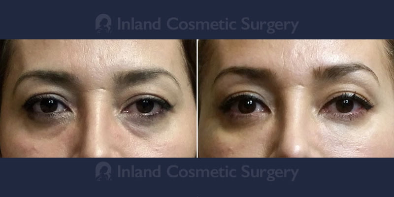 Patient before and after Belotero undereye filler