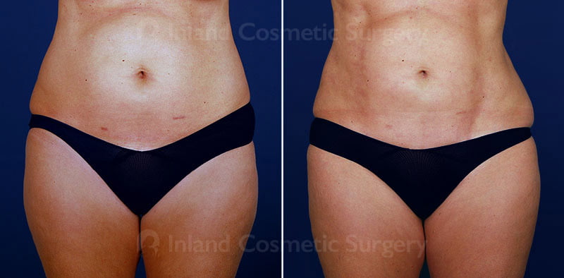 Liposuction Patient