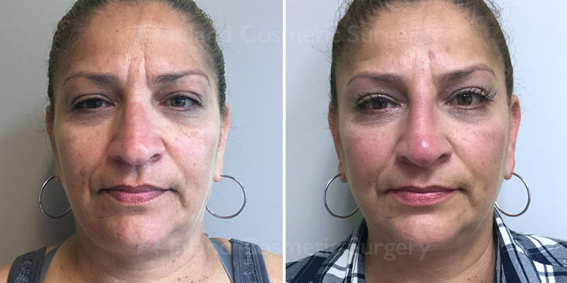 Non-Surgical Rhinoplasty Patient