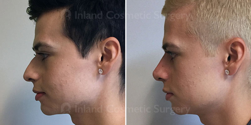 Before and after non-surgical rhinoplasty