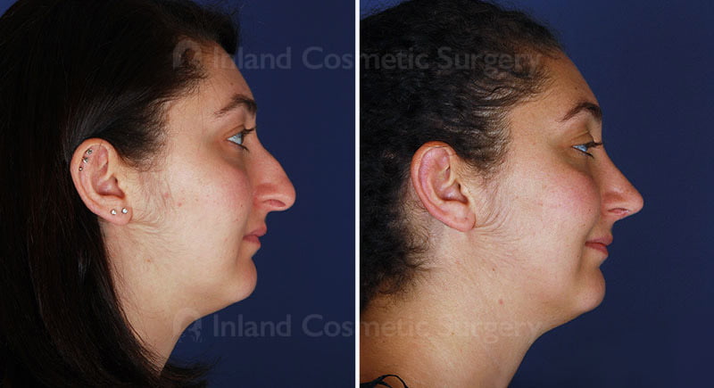 Rhinoplasty Patient