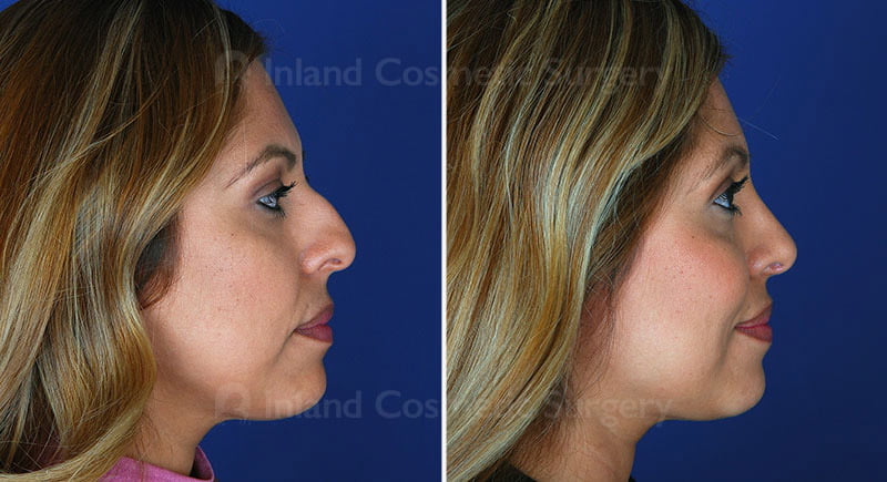 Rhinoplasty Patient