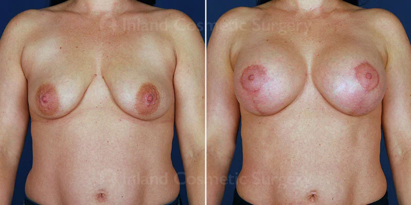 Breast Lift with Augmentation Patient