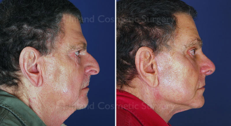 Before and after surgical and non-surgical facial rejuvenation procedures