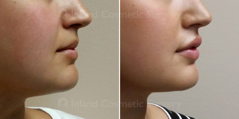 Lip Augmentation Patient