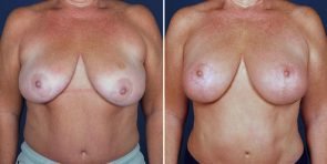 Breast Lift with Natural Augmentation Patient
