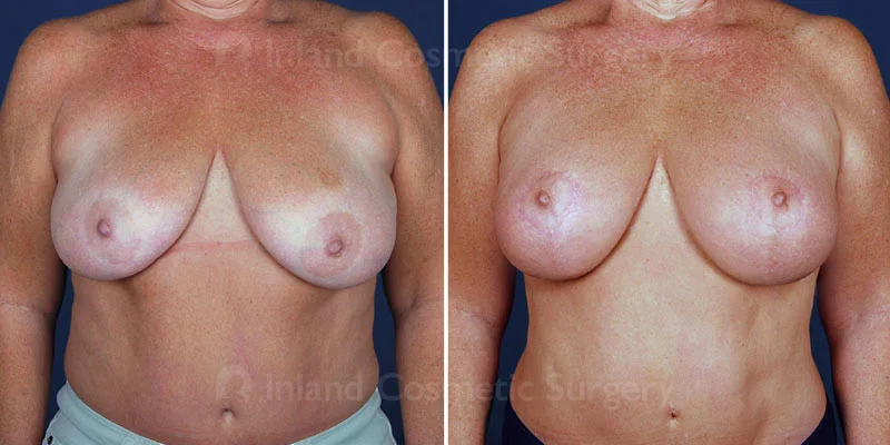Breast Lift with Natural Augmentation Patient