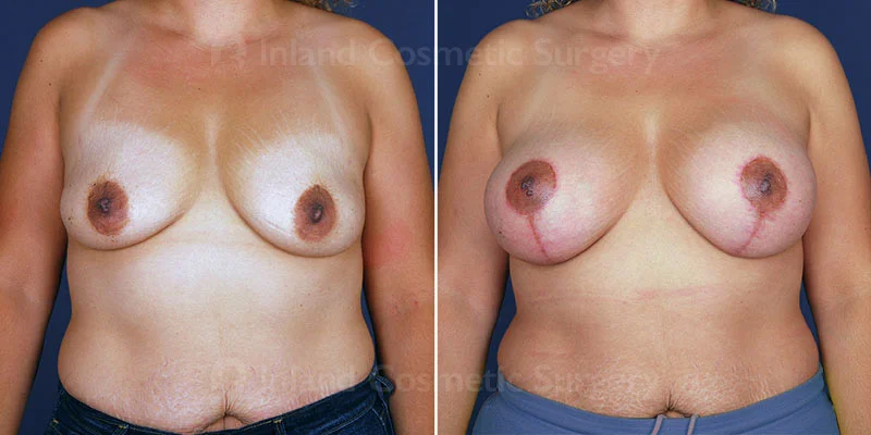 Breast Lift with Augmentation Patient