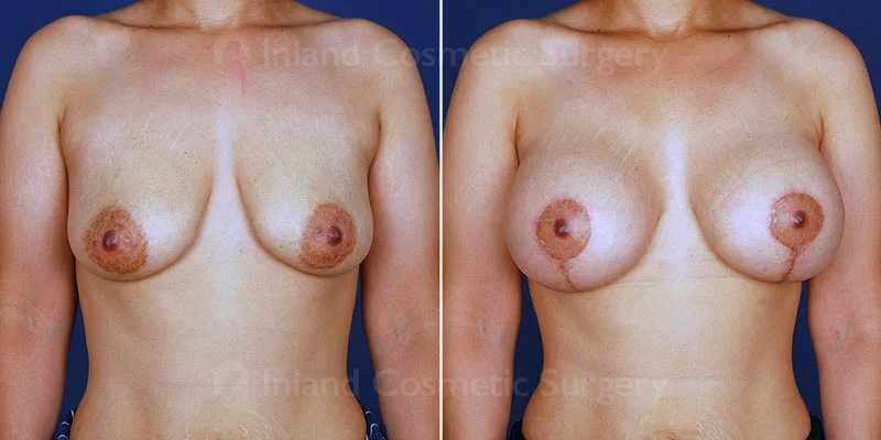 Breast Lift with Augmentation Patient