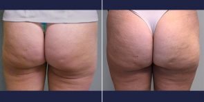 injectable-fillers-buttocks-14796d-haiavy