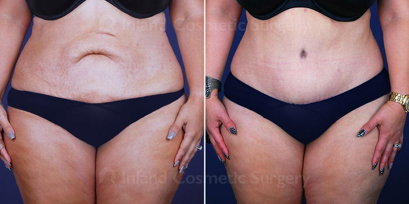 Tummy Tuck with Liposuction Patient