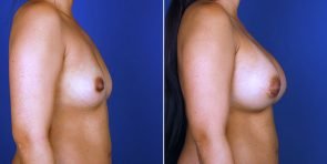 breast-augmentation-15006c-haiavy