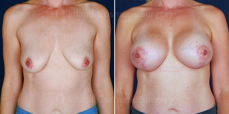 Breast Lift with Augmentation Patient