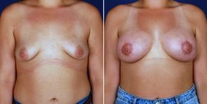 Breast Lift with Augmentation Patient