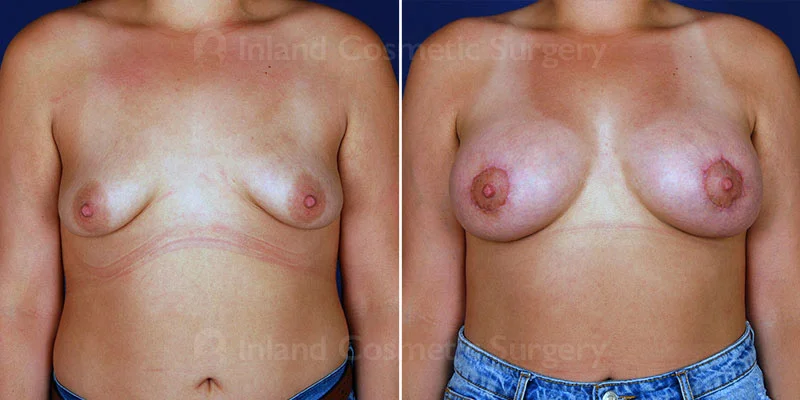 Breast Lift with Augmentation Patient