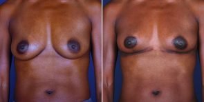 breast-reduction-14934a-haiavy