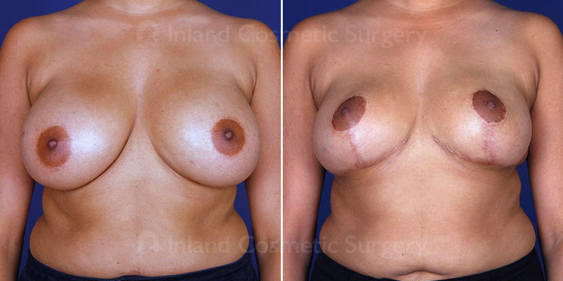 breast-reduction-lift-14959a-haiavy