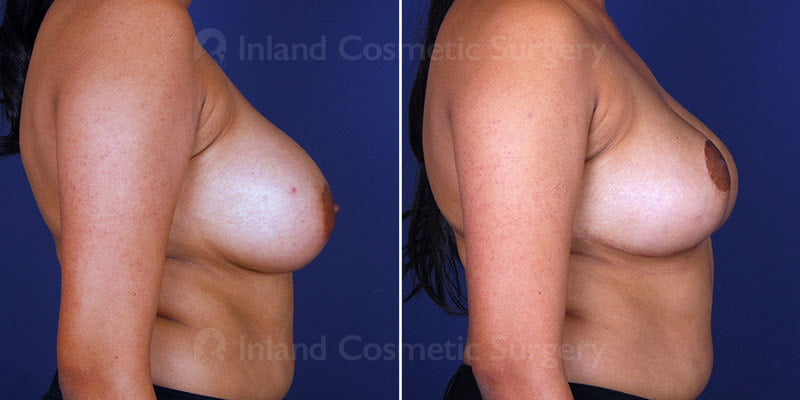 breast-reduction-lift-14959c-haiavy