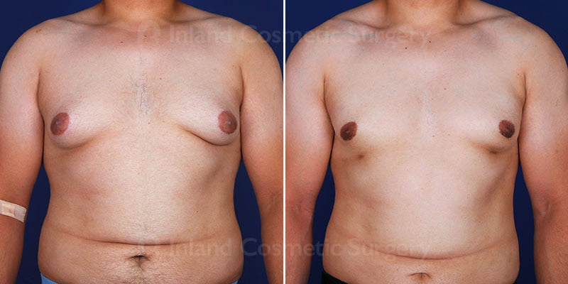 Male Breast Reduction