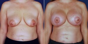 Breast Lift with Augmentation Patient