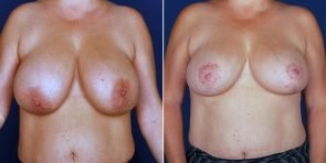 breast-reduction-15228a-inlandcs