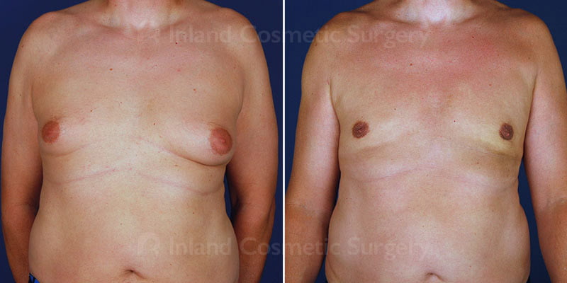 Male Breast Reduction