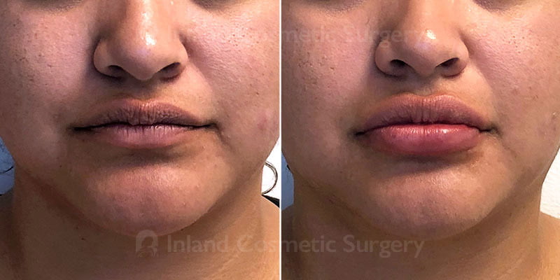 Lip Augmentation Patient