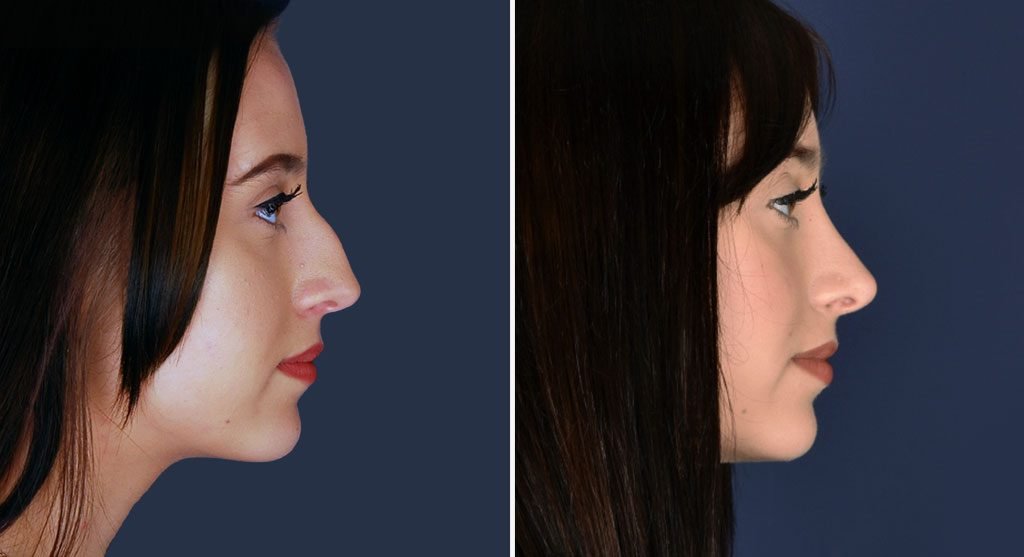 Rhinoplasty Patient