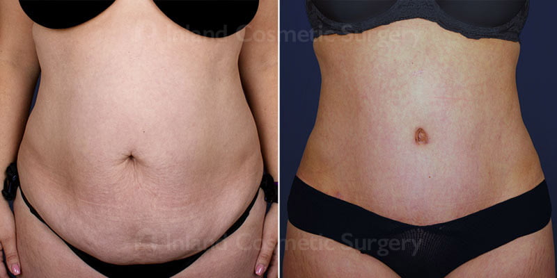 tummy-tuck-liposuction-15115a-inlandcs